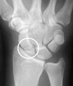 Right wrist x-ray of scaphoid bone fracture.